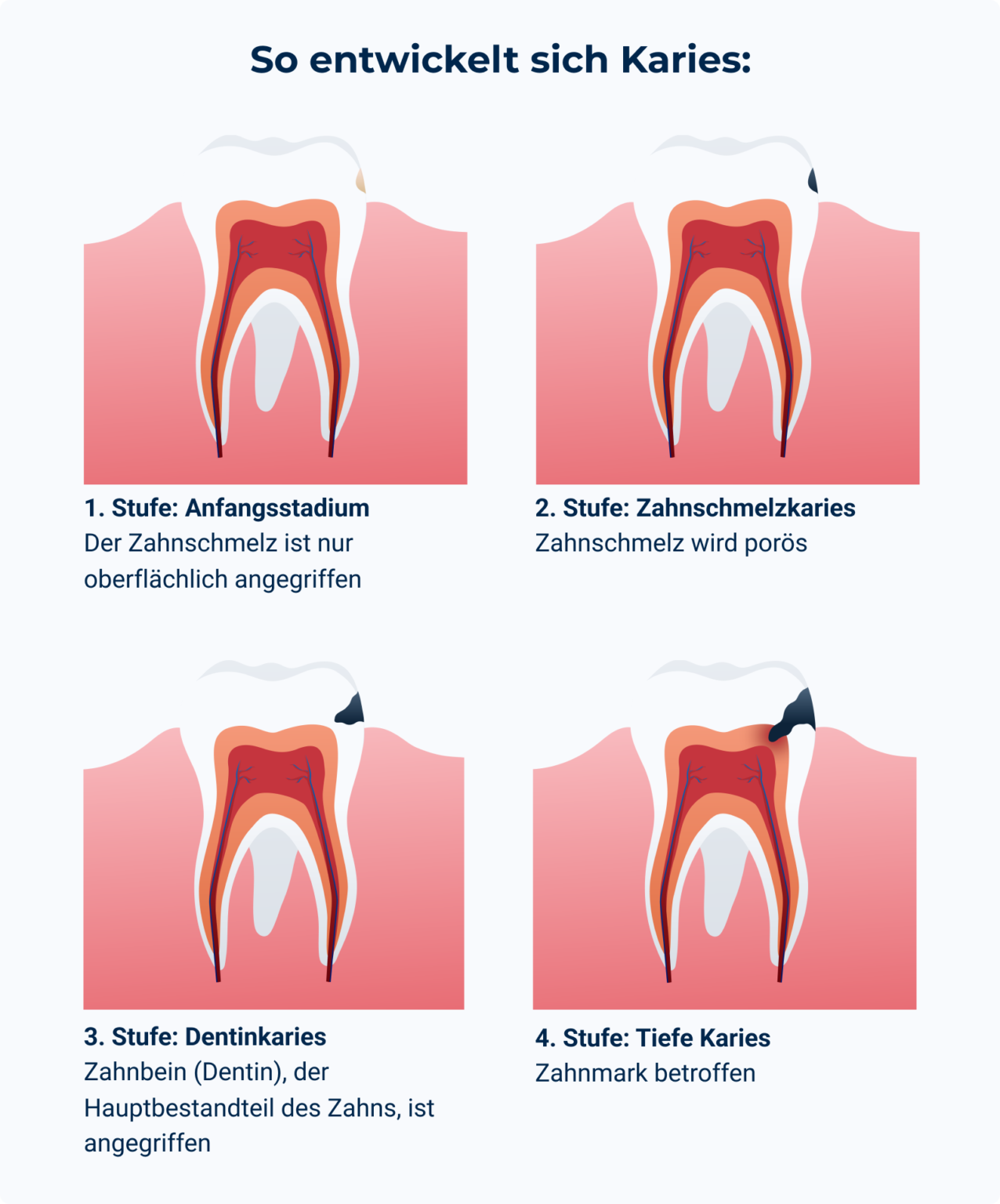 Anfangsstadium Wie Sieht Karies An Milchzähnen Aus Wie entsteht Karies? Symptome erkennen | Doctolib