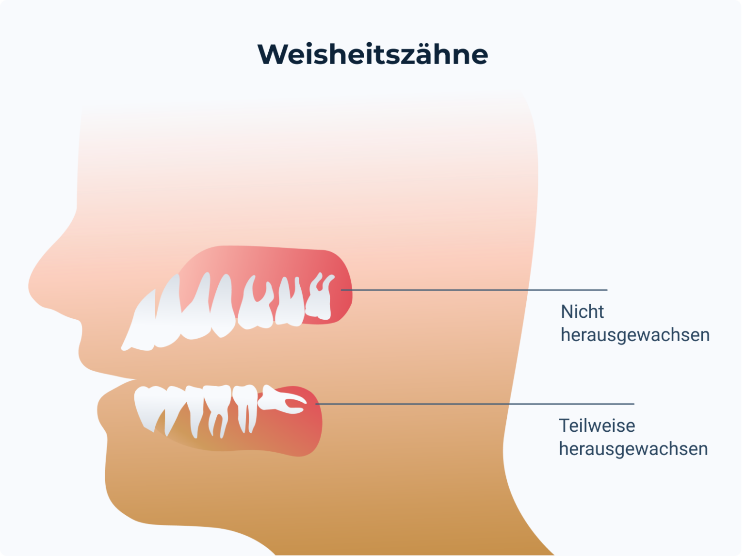 Wie Lange Dauert Weisheitszahn Ziehen www.doctolib.de