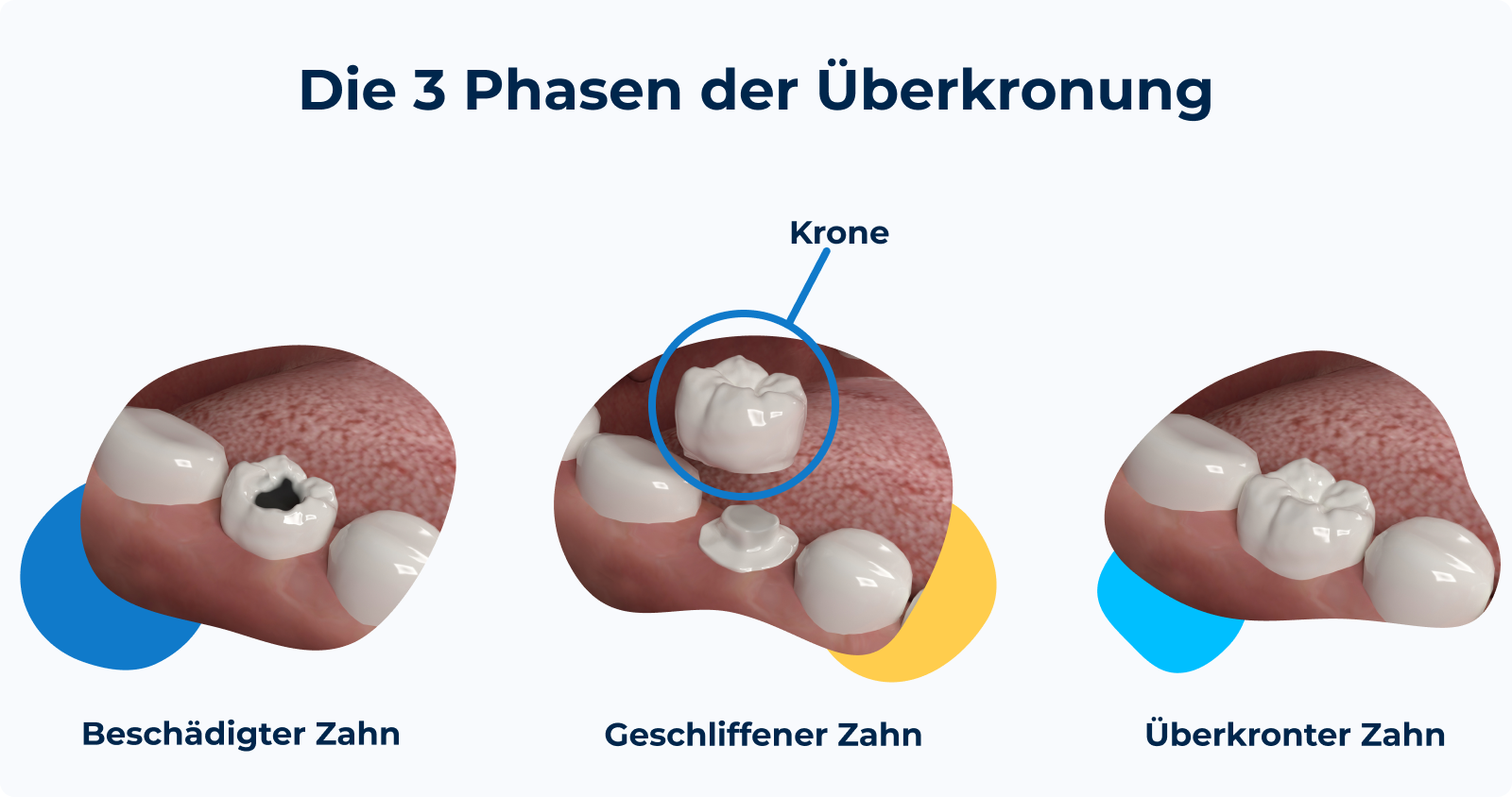Zahn Routon Zahnkrone: Arten, Material & Kosten | Doctolib